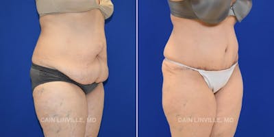 Tummy Tuck (Abdominoplasty) Before & After Gallery - Patient 8522673 - Image 4