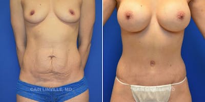 Tummy Tuck (Abdominoplasty) Before & After Gallery - Patient 8522687 - Image 1