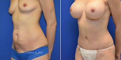 Tummy Tuck (Abdominoplasty) Before & After Gallery - Patient 8522687 - Image 2