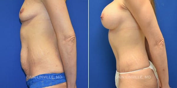 Tummy Tuck (Abdominoplasty) Before & After Gallery - Patient 8522687 - Image 3