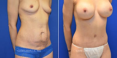 Tummy Tuck (Abdominoplasty) Before & After Gallery - Patient 8522687 - Image 4