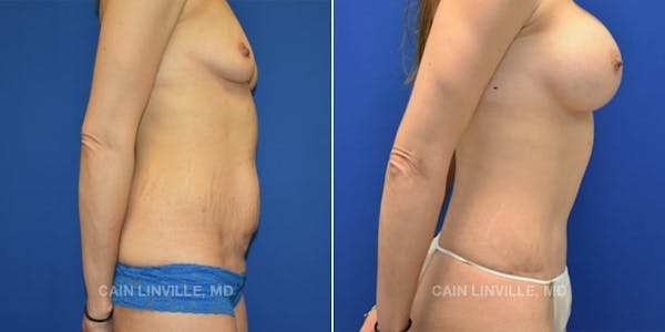 Tummy Tuck (Abdominoplasty) Before & After Gallery - Patient 8522687 - Image 5