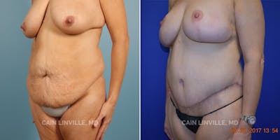 Tummy Tuck (Abdominoplasty) Before & After Gallery - Patient 8522692 - Image 1