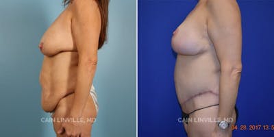 Tummy Tuck (Abdominoplasty) Before & After Gallery - Patient 8522692 - Image 2