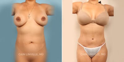 Tummy Tuck (Abdominoplasty) Before & After Gallery - Patient 8522703 - Image 1