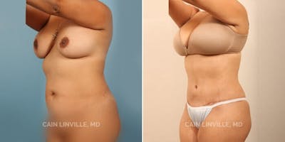 Tummy Tuck (Abdominoplasty) Before & After Gallery - Patient 8522703 - Image 2