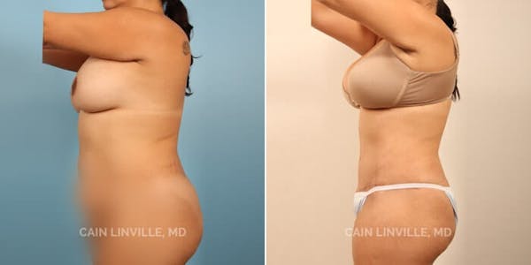 Tummy Tuck (Abdominoplasty) Before & After Gallery - Patient 8522703 - Image 3