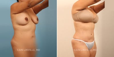 Tummy Tuck (Abdominoplasty) Before & After Gallery - Patient 8522703 - Image 4