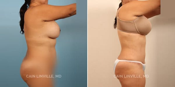 Tummy Tuck (Abdominoplasty) Before & After Gallery - Patient 8522703 - Image 5