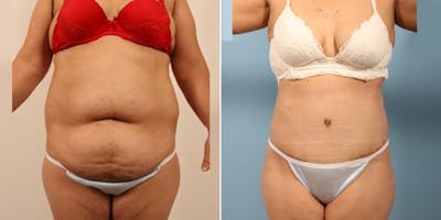 Tummy Tuck (Abdominoplasty) Before & After Gallery - Patient 8522715 - Image 1