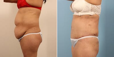 Tummy Tuck (Abdominoplasty) Before & After Gallery - Patient 8522715 - Image 2