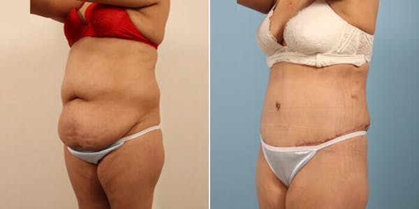 Tummy Tuck (Abdominoplasty) Before & After Gallery - Patient 8522715 - Image 3