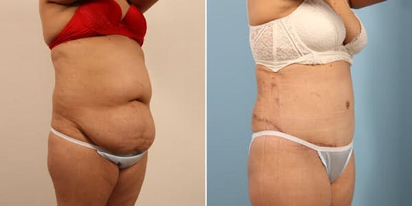 Tummy Tuck (Abdominoplasty) Before & After Gallery - Patient 8522715 - Image 4