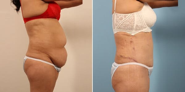 Tummy Tuck (Abdominoplasty) Before & After Gallery - Patient 8522715 - Image 5