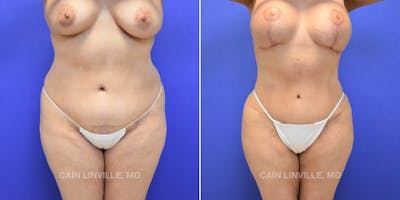 Tummy Tuck (Abdominoplasty) Before & After Gallery - Patient 8522740 - Image 1