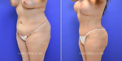 Tummy Tuck (Abdominoplasty) Before & After Gallery - Patient 8522740 - Image 2