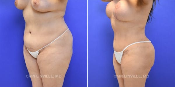 Tummy Tuck (Abdominoplasty) Before & After Gallery - Patient 8522740 - Image 2