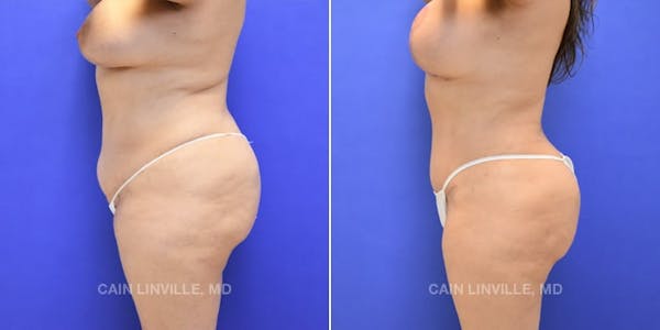 Tummy Tuck (Abdominoplasty) Before & After Gallery - Patient 8522740 - Image 3