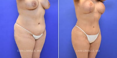 Tummy Tuck (Abdominoplasty) Before & After Gallery - Patient 8522740 - Image 4