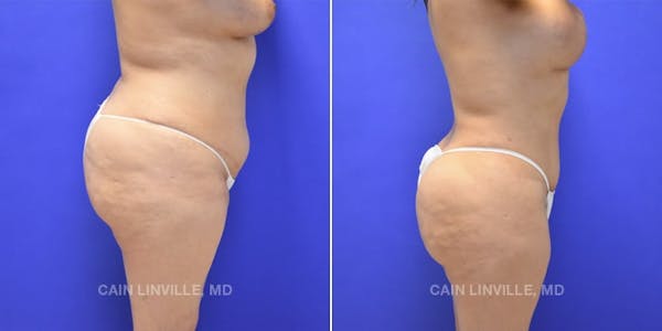 Tummy Tuck (Abdominoplasty) Before & After Gallery - Patient 8522740 - Image 5