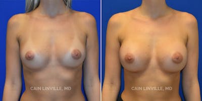 Breast Augmentation Before & After Gallery - Patient 8522753 - Image 1