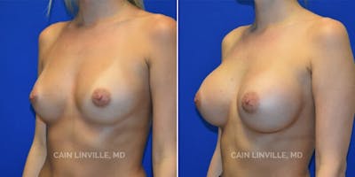 Breast Augmentation Before & After Gallery - Patient 8522753 - Image 2
