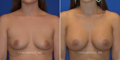 Breast Augmentation Before & After Gallery - Patient 8522766 - Image 1