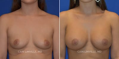 Breast Augmentation Gallery - Patient 8522766 - Image 1