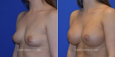 Breast Augmentation Before & After Gallery - Patient 8522766 - Image 2