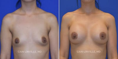 Breast Augmentation Before & After Gallery - Patient 8522784 - Image 1