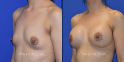 Breast Augmentation Before & After Gallery - Patient 8522784 - Image 2