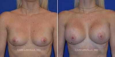 Breast Augmentation Before & After Gallery - Patient 8522802 - Image 1