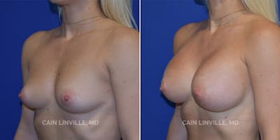 Breast Augmentation Before & After Gallery - Patient 8522802 - Image 2