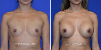 Breast Augmentation Before & After Gallery - Patient 8522816 - Image 1