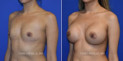 Breast Augmentation Before & After Gallery - Patient 8522816 - Image 2