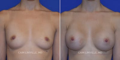 Breast Augmentation Before & After Gallery - Patient 8522833 - Image 1