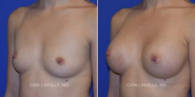 Breast Augmentation Before & After Gallery - Patient 8522833 - Image 2