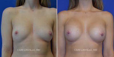 Breast Augmentation Before & After Gallery - Patient 8522845 - Image 1