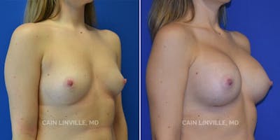 Breast Augmentation Before & After Gallery - Patient 8522845 - Image 2