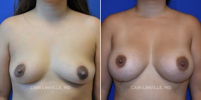 Breast Augmentation Before & After Gallery - Patient 8522864 - Image 1