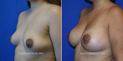 Breast Augmentation Before & After Gallery - Patient 8522864 - Image 2
