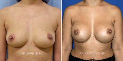 Breast Augmentation Before & After Gallery - Patient 8522879 - Image 1