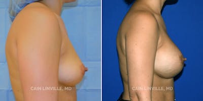 Breast Augmentation Before & After Gallery - Patient 8522879 - Image 2