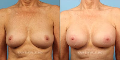 Breast Augmentation Before & After Gallery - Patient 8522899 - Image 1