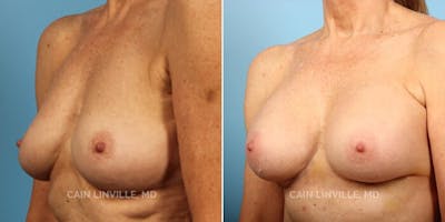 Breast Augmentation Before & After Gallery - Patient 8522899 - Image 2