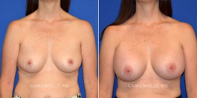 Breast Augmentation Before & After Gallery - Patient 8522925 - Image 1