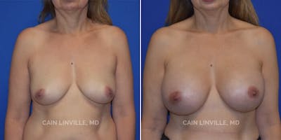 Breast Augmentation Before & After Gallery - Patient 8522938 - Image 1
