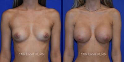 Breast Augmentation Before & After Gallery - Patient 8522954 - Image 1