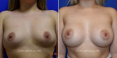 Breast Augmentation Before & After Gallery - Patient 8522975 - Image 1