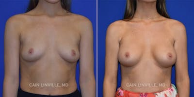 Breast Augmentation Before & After Gallery - Patient 8522993 - Image 1